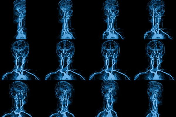 MRI vs MRA: What’s the Difference and When Each Is Used