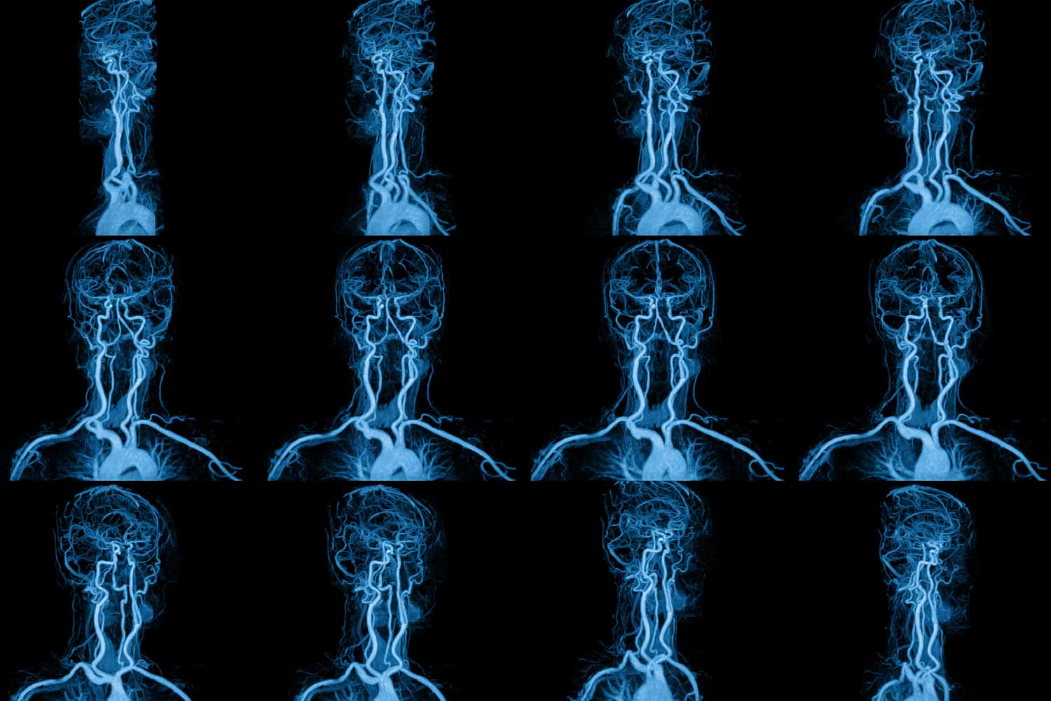 MRI vs MRA: What’s the Difference and When Each Is Used