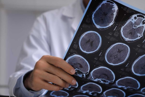 How Radiology Helps Diagnose and Monitor Multiple Sclerosis