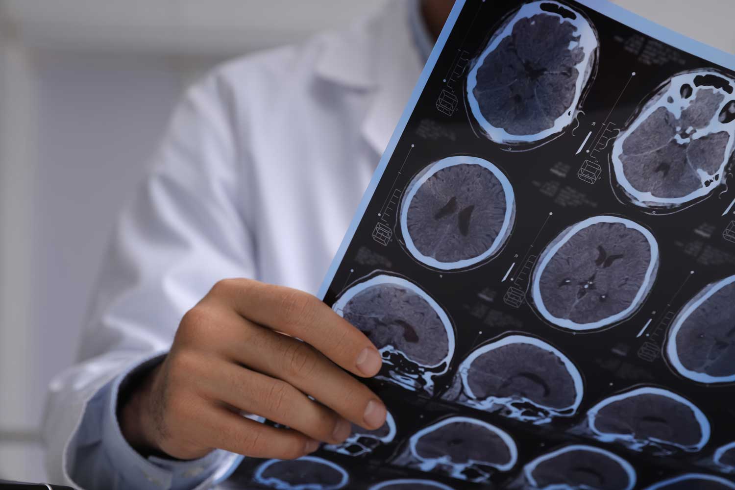 How Radiology Helps Diagnose and Monitor Multiple Sclerosis