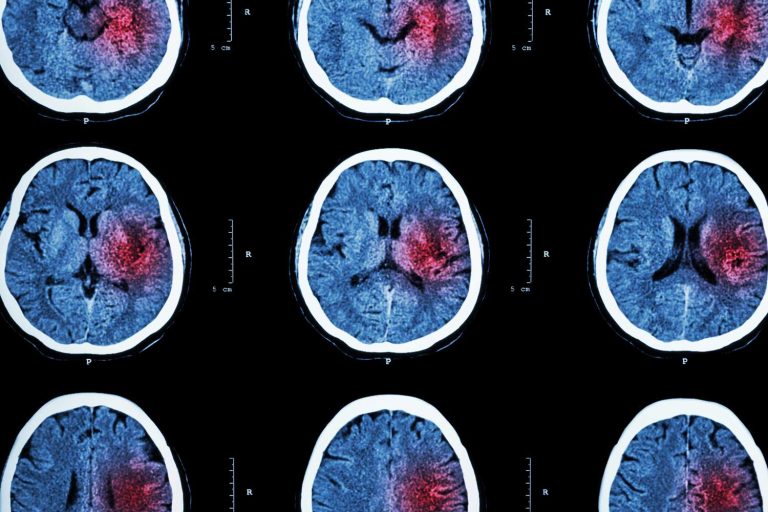 What Test Shows If You Had a Stroke?