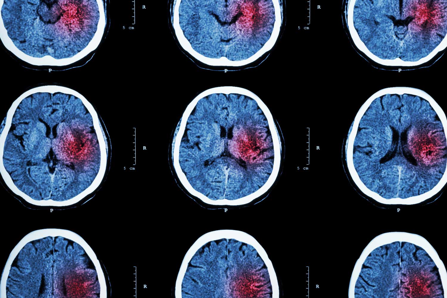 What Test Shows If You Had a Stroke?