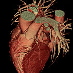 Coronary CTA