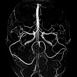 Magnetic Resonance Angiography