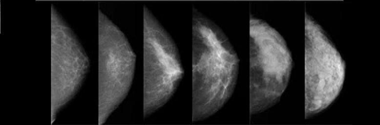 How is breast density determined?