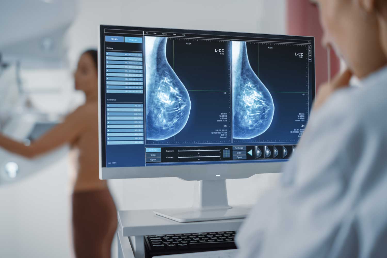 Breast Density Measurement May Predict Cancer Risk
