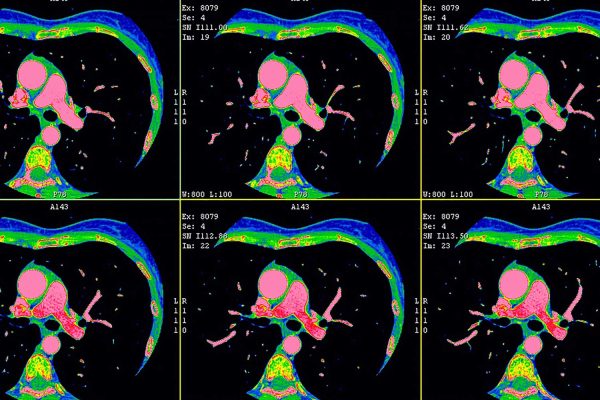 cardiac CT angiography