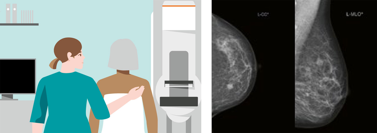 Mammography in Breast Cancer: Background, X-ray Mammography