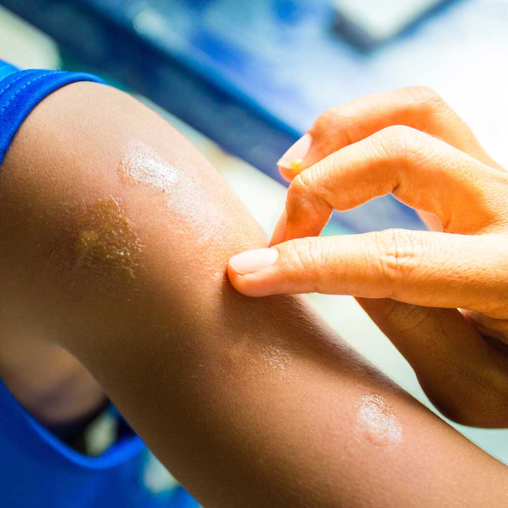 Care for Bites and Stings
