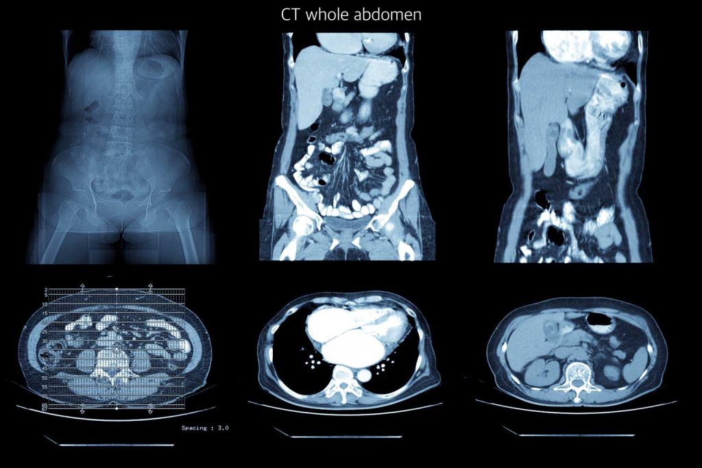 Abdominal CT Scan: What It Shows and What to Expect - IPMC ...