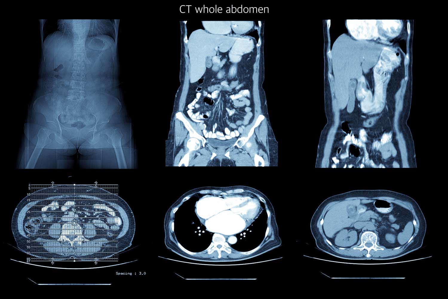 Abdominal Whole CT Scan