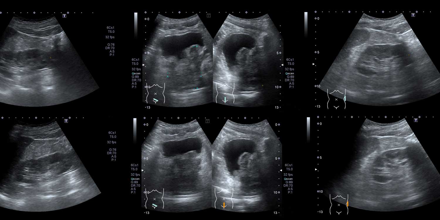 Bladder Ultrasound: What It Shows, Why It’s Done, and What to Expect