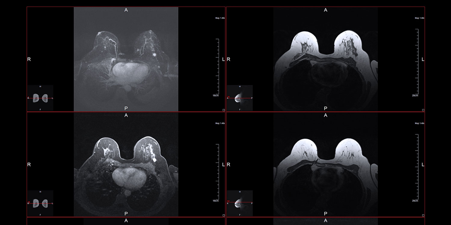 Breast MRI Scan — IPMC Northeast Philadelphia radiology Breast MRI scan image used for cancer screening and dense tissue evaluation