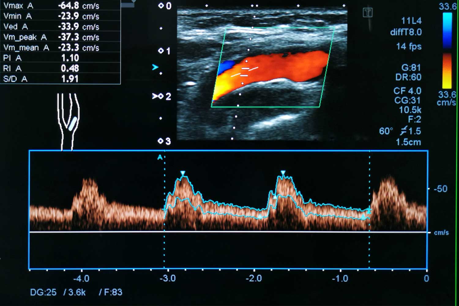 Color Doppler ultrasound image of left internal carotid artery with pulse waveform