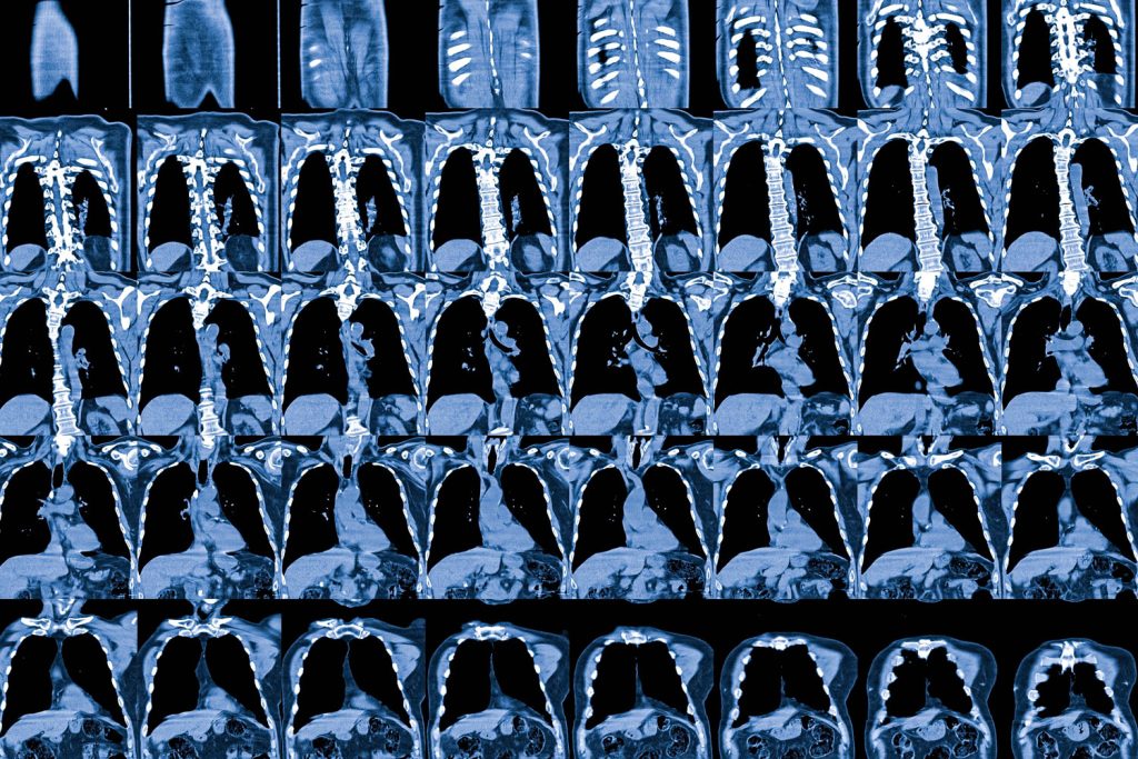 Chest MRI Scan in Philadelphia | Heart, Lungs & More | IPMC