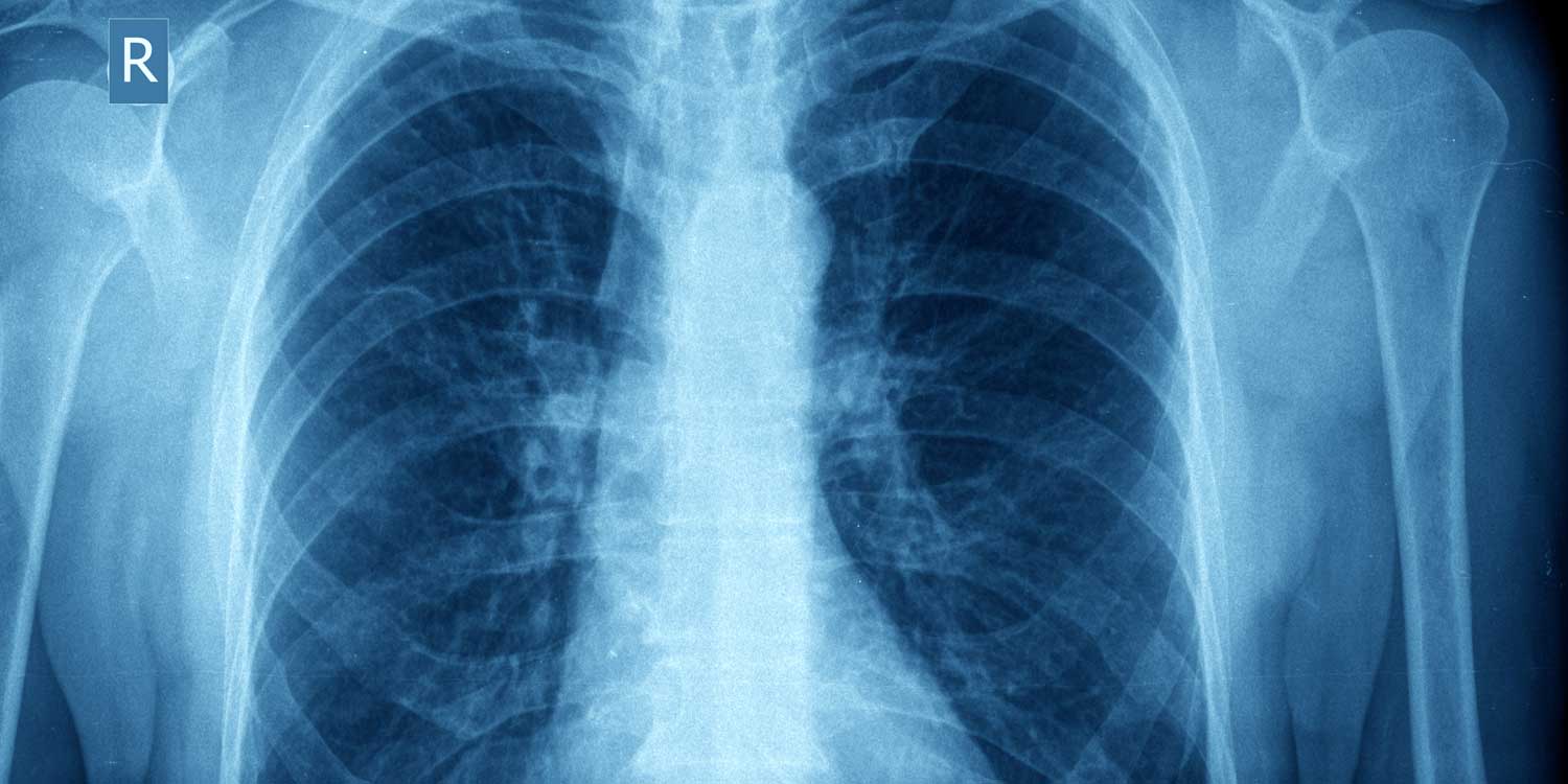 Chest X-Ray Image — IPMC Radiology, Northeast Philadelphia Chest X-ray image showing lungs, heart, and ribs at IPMC radiology Philadelphia