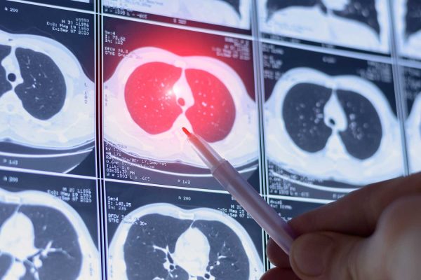 CT Scan for Emphysema and COPD: How Imaging Helps Assess Lung Health