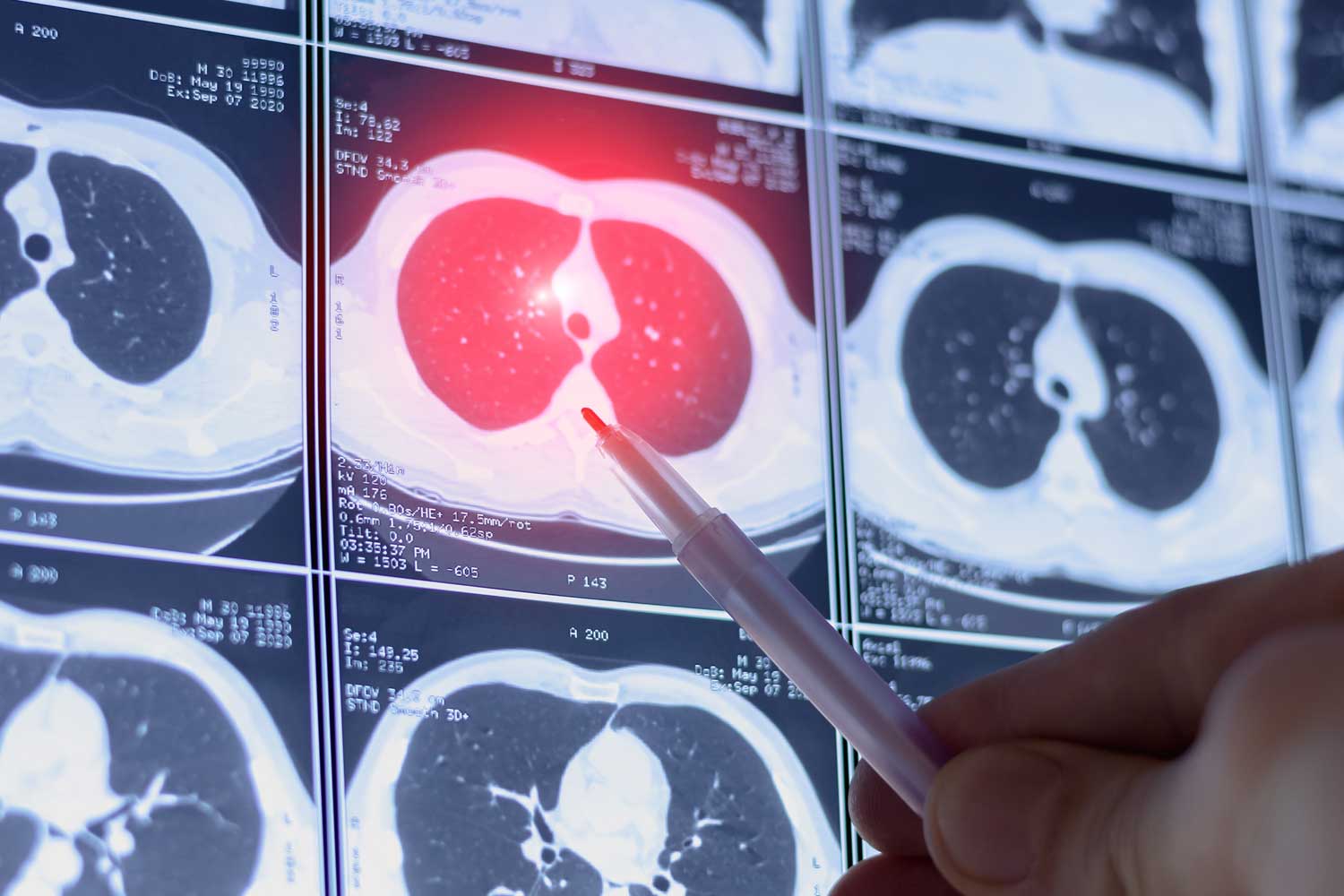 CT Scan for Emphysema and COPD: How Imaging Helps Assess Lung Health
