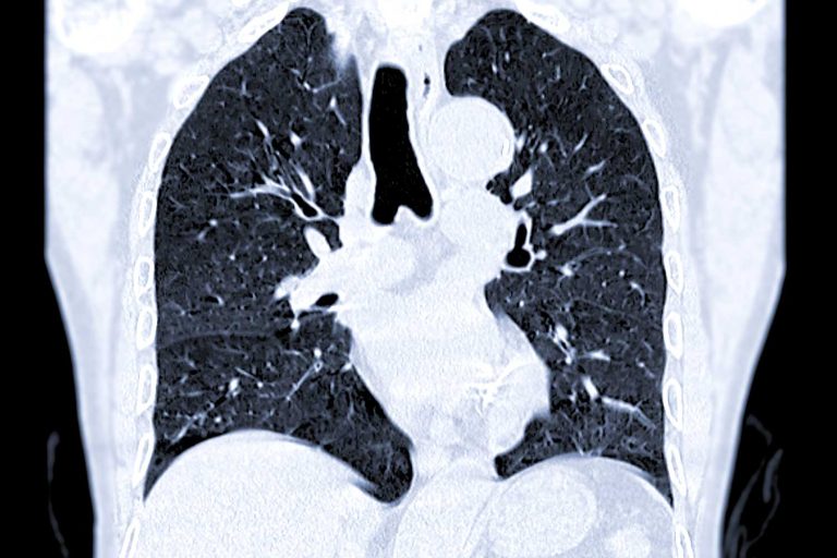 CT Scan for Pulmonary Embolism: The Gold Standard in Diagnosis