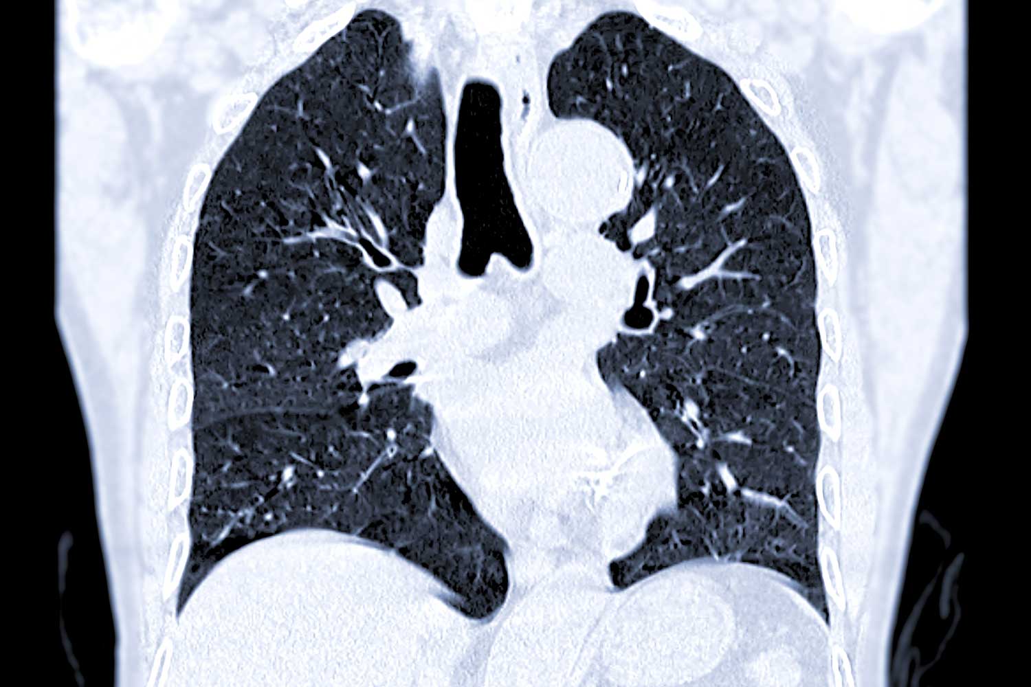 CT Scan for Pulmonary Embolism: The Gold Standard in Diagnosis