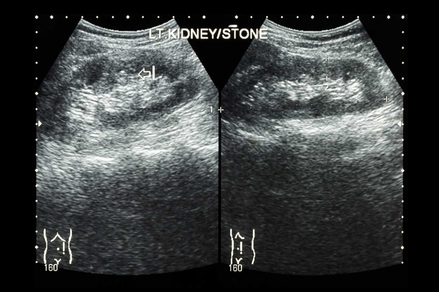 Ultrasonography of kidney shows left kidney stones