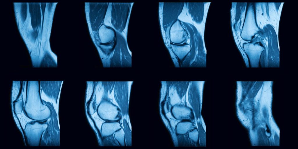 Knee MRI Scan in Philadelphia | ACL, Meniscus & More | IPMC