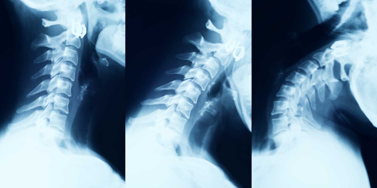 Lateral cervical spine X-ray showing vertebrae C1 to C7 at IPMC radiology Philadelphia