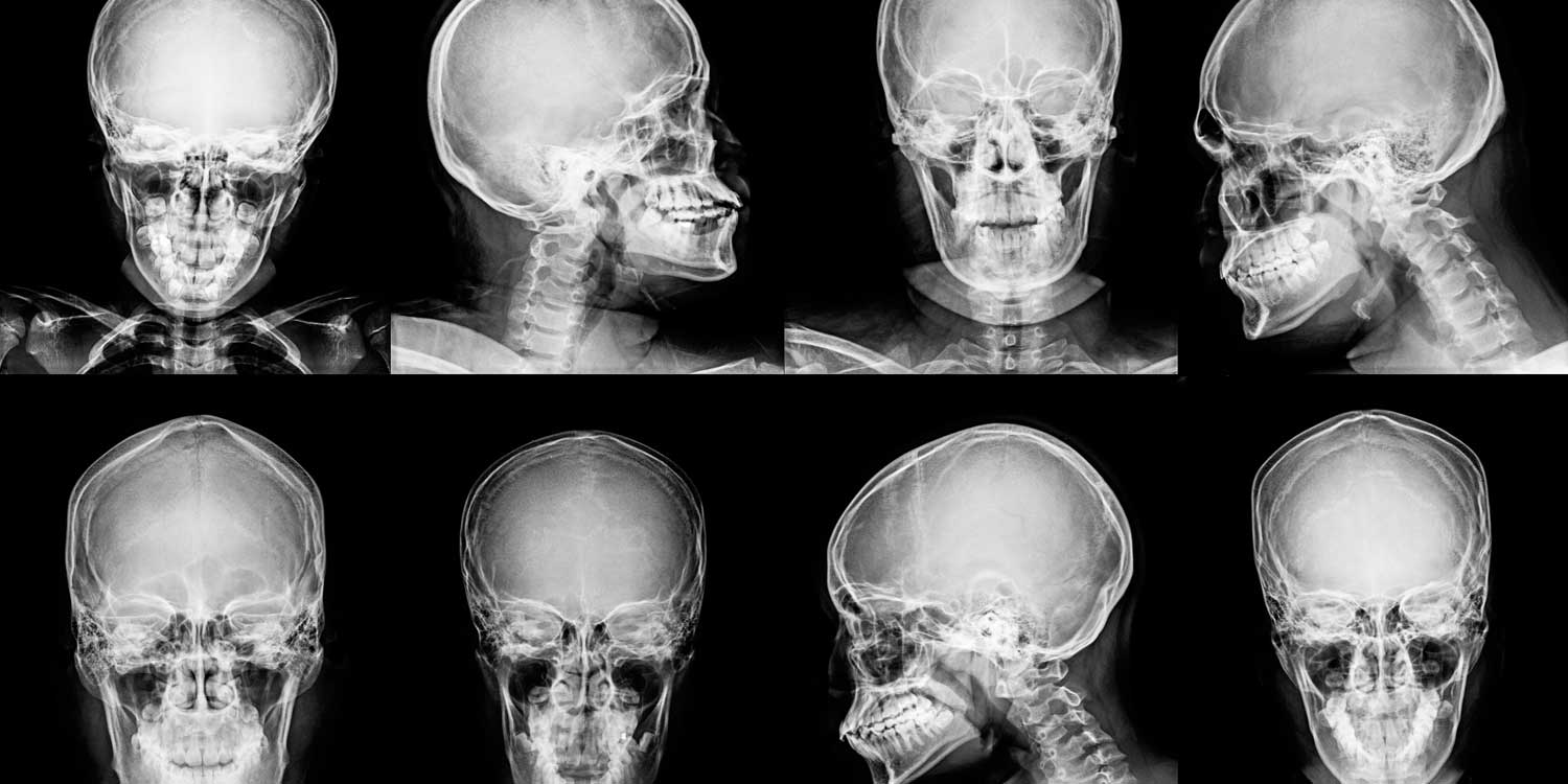 Lateral skull X-ray showing cranial vault bones and sutures at IPMC radiology Philadelphia