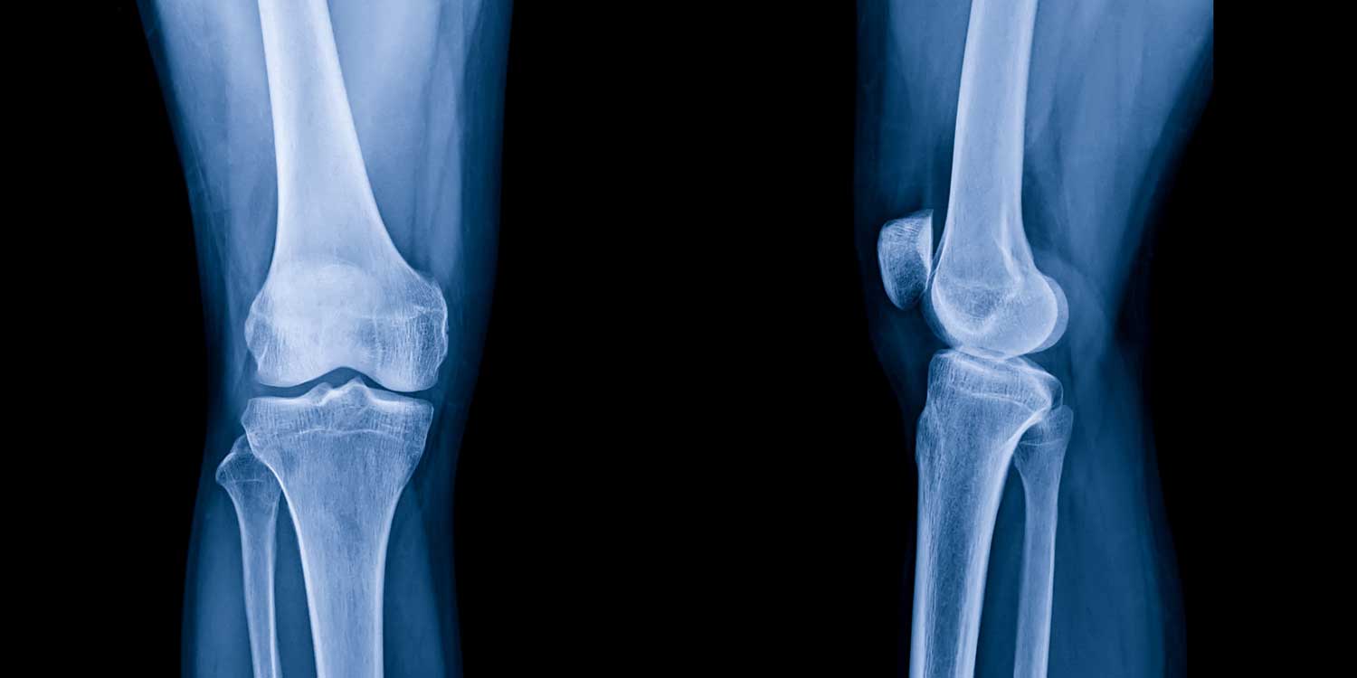 Standing AP knee X-ray showing medial compartment joint space narrowing and osteophytes at IPMC Philadelphia